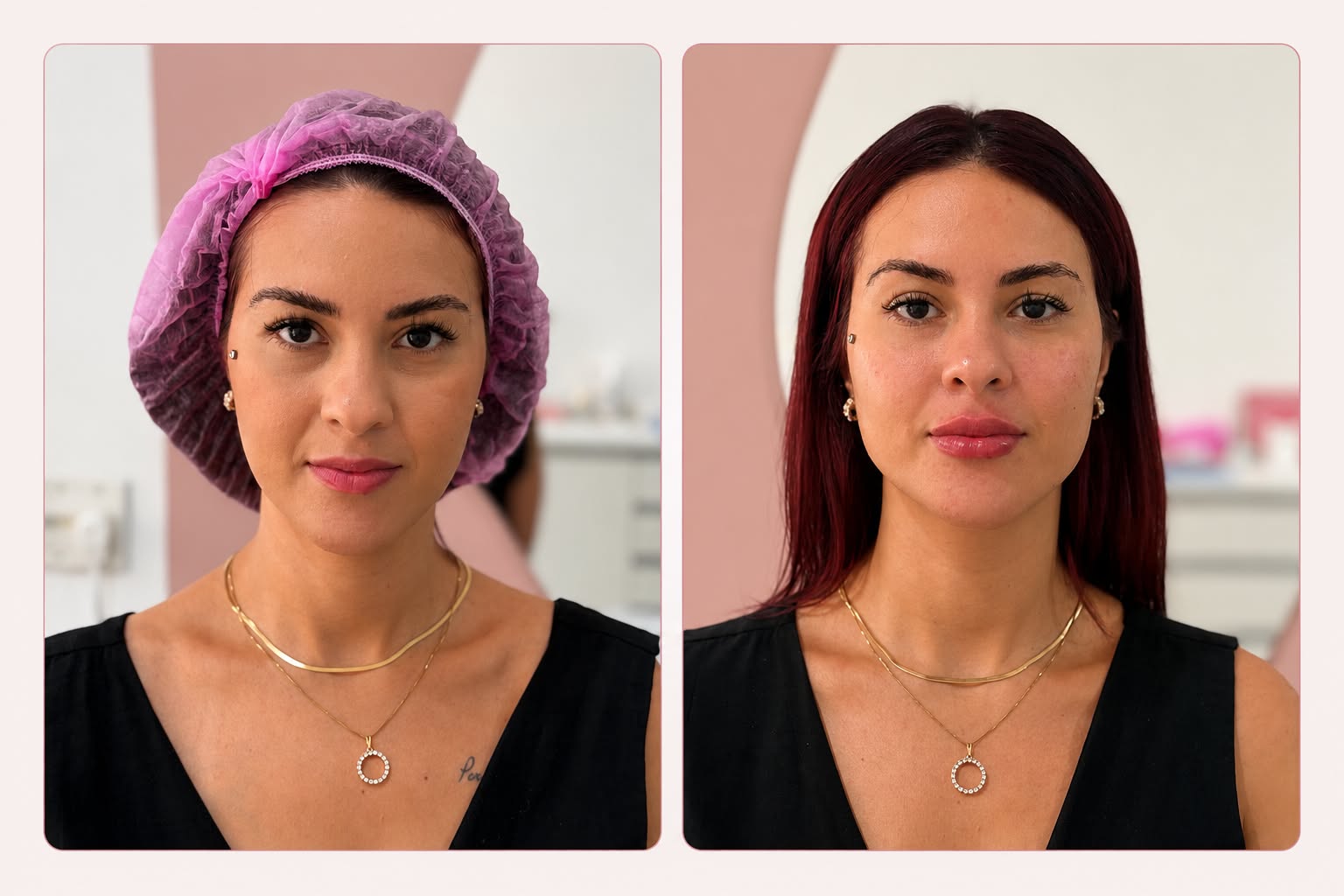 Preenchimento Labial